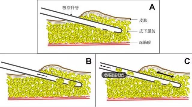 半永久化妝是微整形嗎？?jī)烧哂惺裁磪^(qū)別？